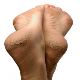 foot fungus cracked heels